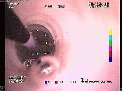 Darstellung der Speiseröhre mit dem Endoskop. Der Ballon erweitert die Verengung