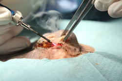 Abtrennen des Tumors mit chirurgischen Laser